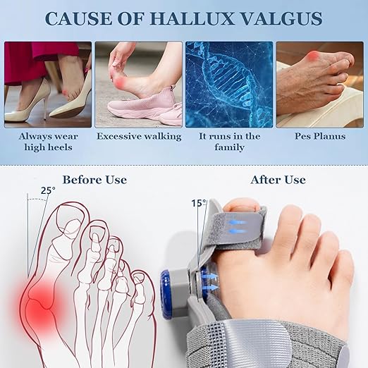 FeetifFix - Bunion Corrector